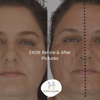 EXO|E® Before and Afters – Free Downloads
