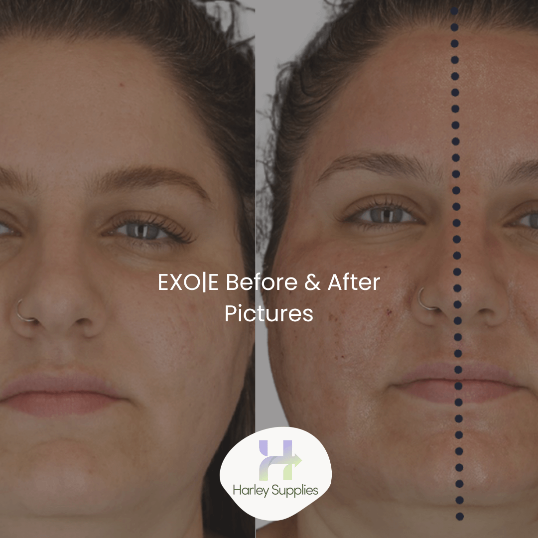 EXO|E® Before and Afters – Free Downloads