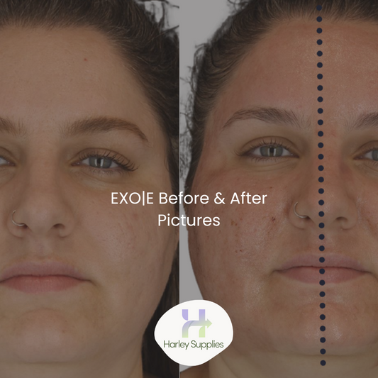 EXO|E® Before and Afters – Free Downloads