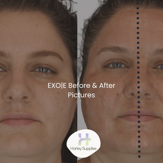 EXO|E® Before and Afters – Free Downloads